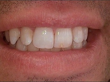 Teeth after bleaching