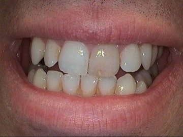Before Teeth Bleaching
