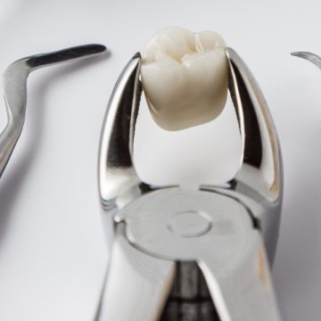 Why You May Need a Tooth Extraction