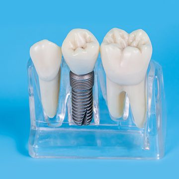 Consider a Dental Implant If You Are Recommended Restorative Dentistry