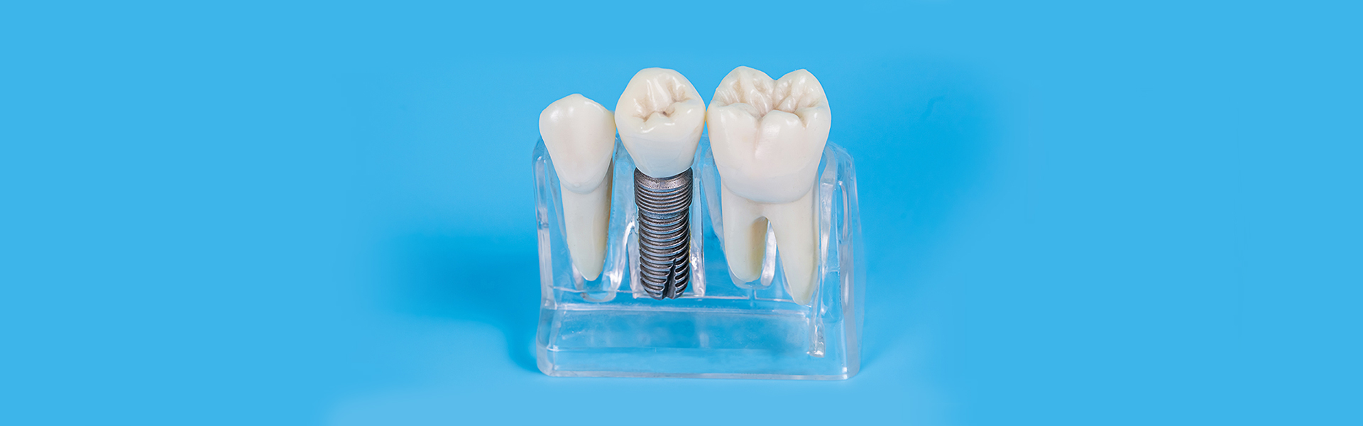 Consider a Dental Implant If You Are Recommended Restorative Dentistry