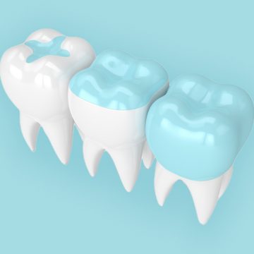 What Are Dental Inlays and Onlays and How Do You Benefit from Them?