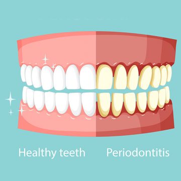 Diagnosing Periodontal Disease