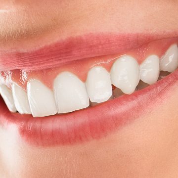 How Can A Smile Makeover Change Your Life?