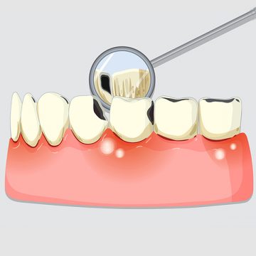 Understanding Periodontal Disease and Treatment Options