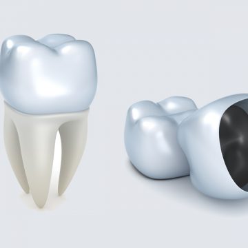 Detailing the Advantages of Dental Crowns