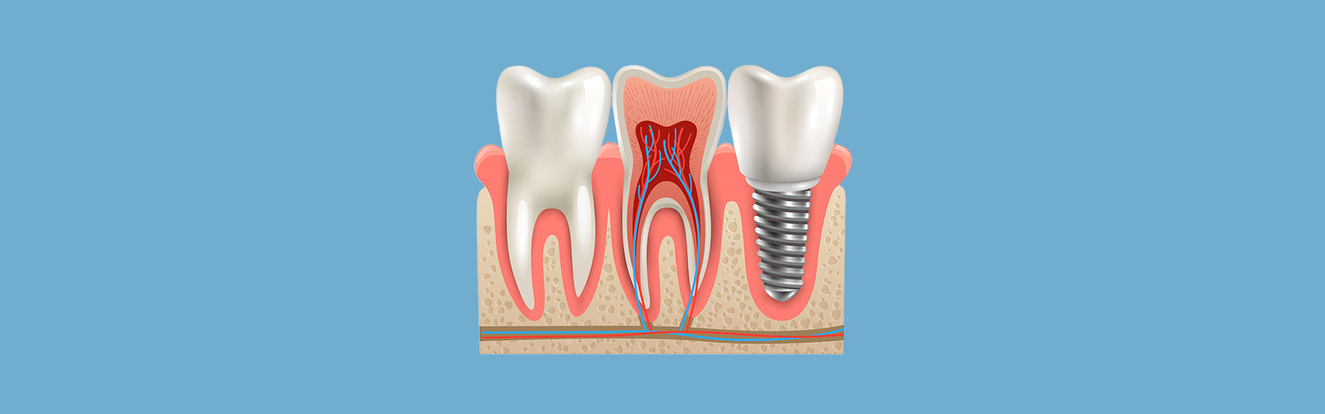 How to Be Ready for Your Dental Implant Procedure in Calgary?
