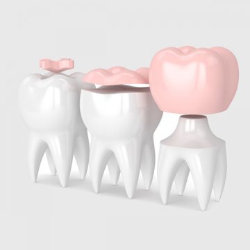 The Benefits of Choosing Porcelain Inlays and Onlays Over Fillings
